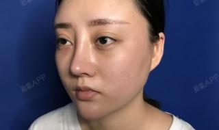 鼻息肉手术大约需要多少钱 做鼻子要多少钱